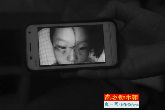 8月26日，受害小女孩包扎前所拍攝的樣貌。實習生